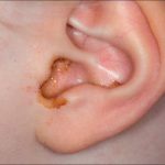 Middle Ear Infection And Hearing Loss