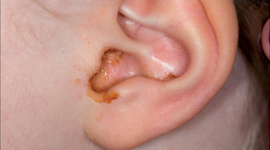 Middle Ear Infection And Hearing Loss
